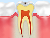 C1 【エナメル質の虫歯】