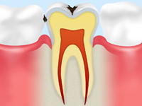 C2 【象牙質の虫歯】