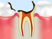 C3 【神経まで達した虫歯】