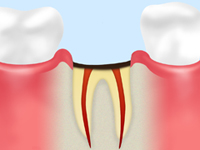 C4 【歯根まで達した虫歯】