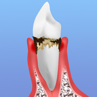 中等度歯周炎