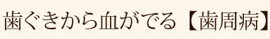 歯ぐきから血がでる【歯周病】